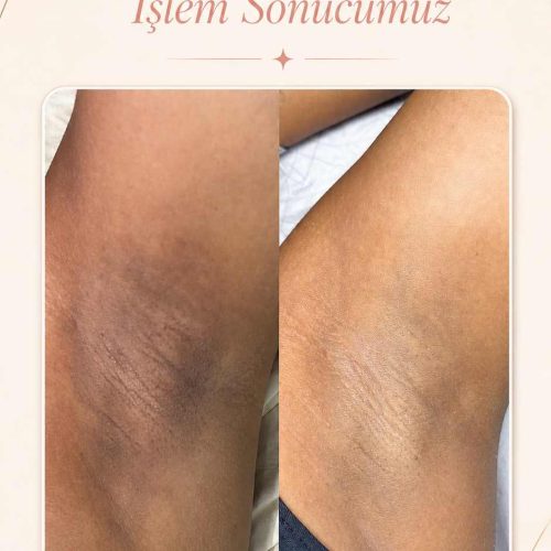 Beyazlatma uygulaması öncesi ve sonrası görünüm – Kadıköy Bostancı