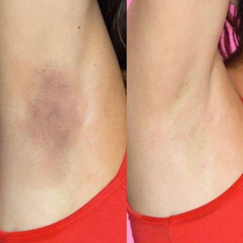 Bikini bölgesi kararma görünümü için beyazlatma uygulaması öncesi ve sonrası