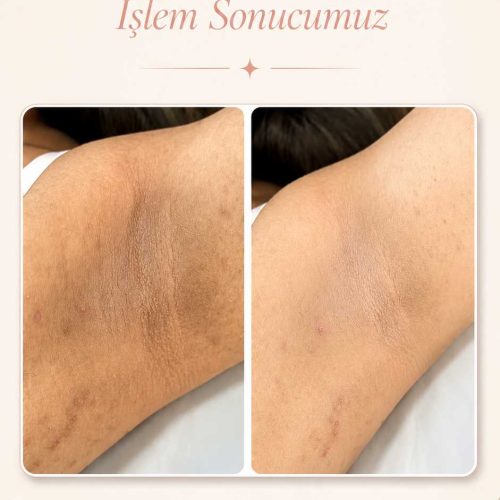 Bölgesel beyazlatma uygulaması öncesi ve sonrası karşılaştırması