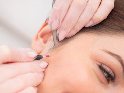 Kadıköy iğneli epilasyon uygulaması ve elektroliz epilasyon işlemi