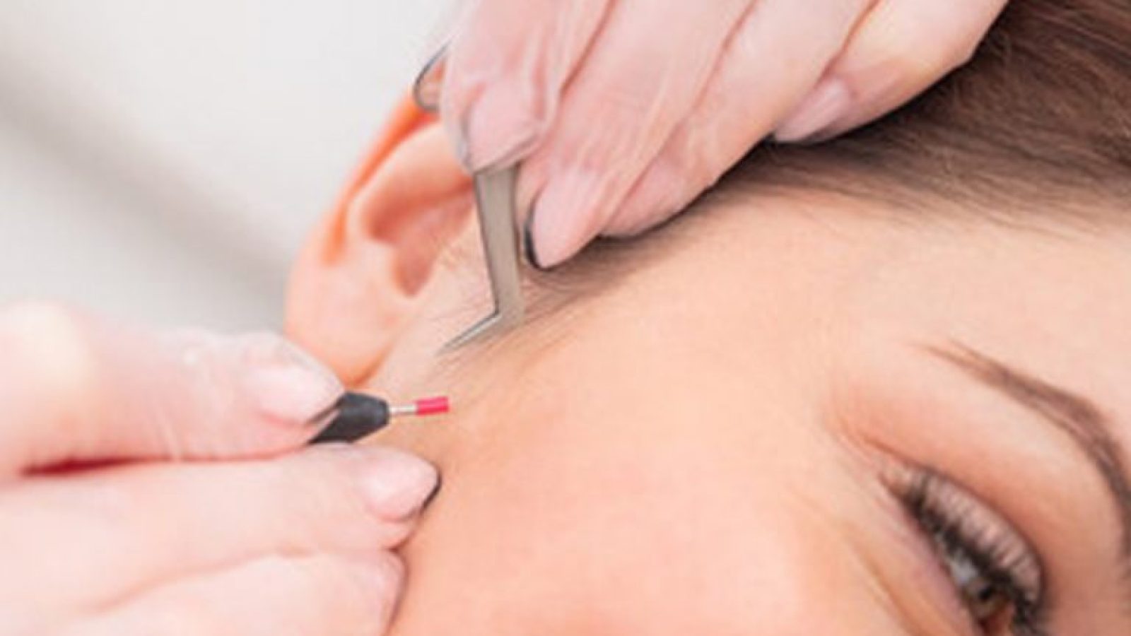 Kadıköy Bostancı Lily's Beauty Studio iğneli epilasyon uygulaması