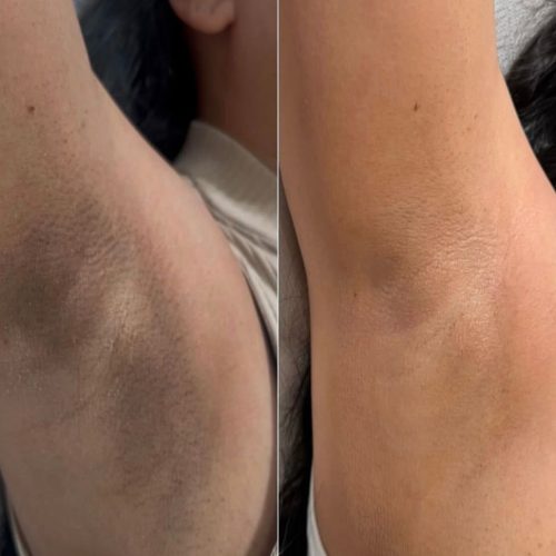 Bostancı koltuk altı kararması bakımı öncesi sonrası fotoğrafı