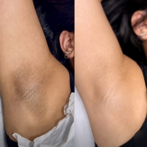 Kadıköy koltuk altı ton eşitsizliği bakım sonucu